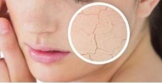 皮肤干燥怎么办 脸部皮肤干燥起皮护肤方法分享