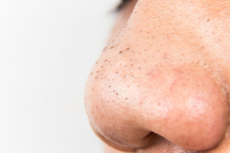 鼻子周围好多粉刺黑头怎么办 消除改善鼻子粉刺黑头方法 